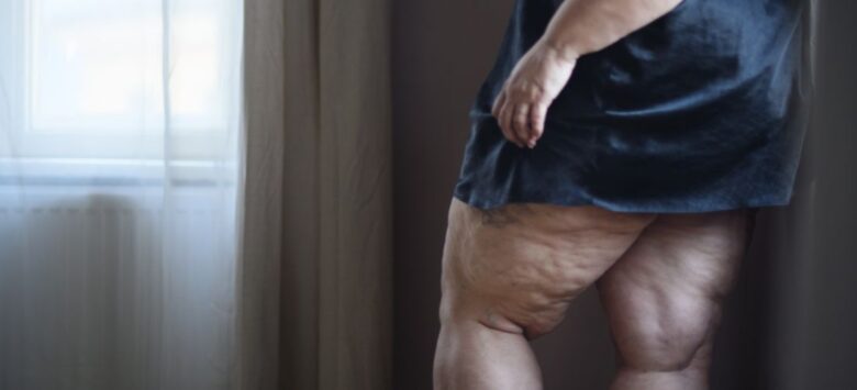 Cellulite Grades: How to Identify and Treat Each Stage