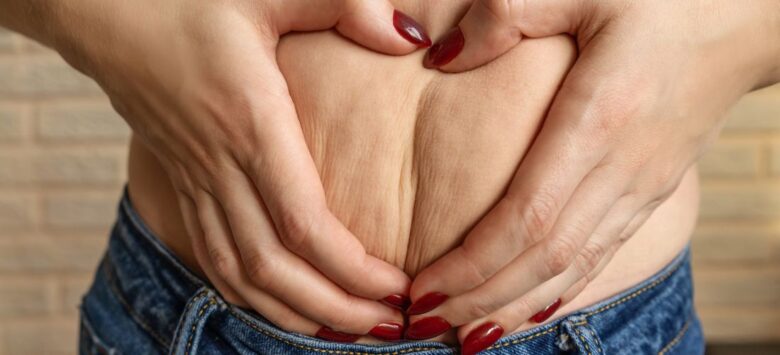 Common Misconceptions About Cellulite