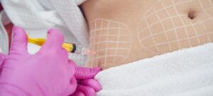 Comparing Invasive vs. Non-Invasive Cellulite Treatments