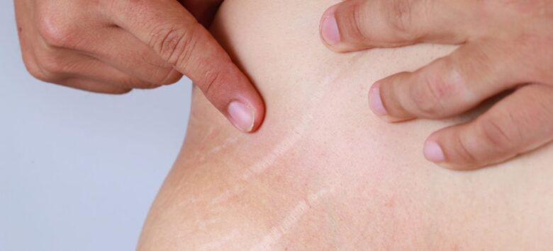 Stretch Marks in Adolescents: Causes and Solutions