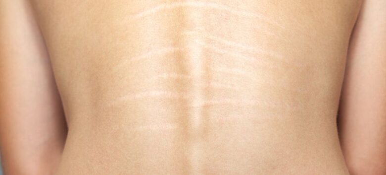 The Different Types of Stretch Marks Explained