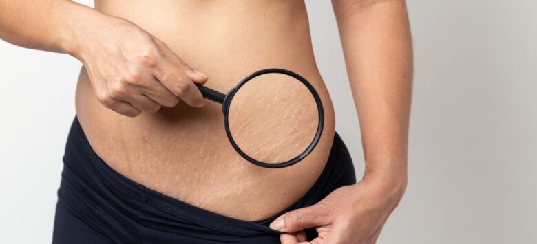 The Effectiveness of Retinoids in Stretch Mark Treatment