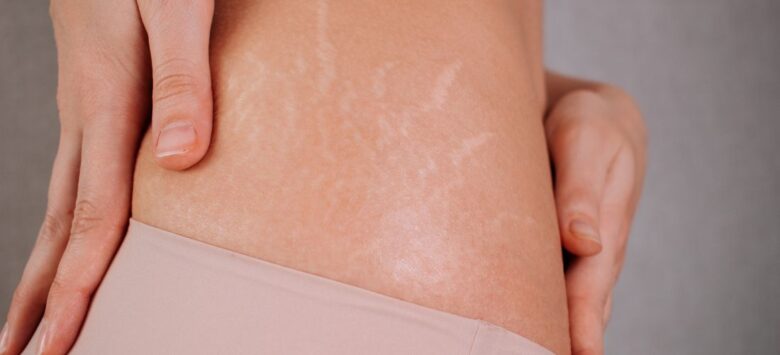 Topical Treatments for Reducing Cellulite: What Works?