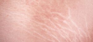 What Causes Stretch Marks and Who Is at Risk?