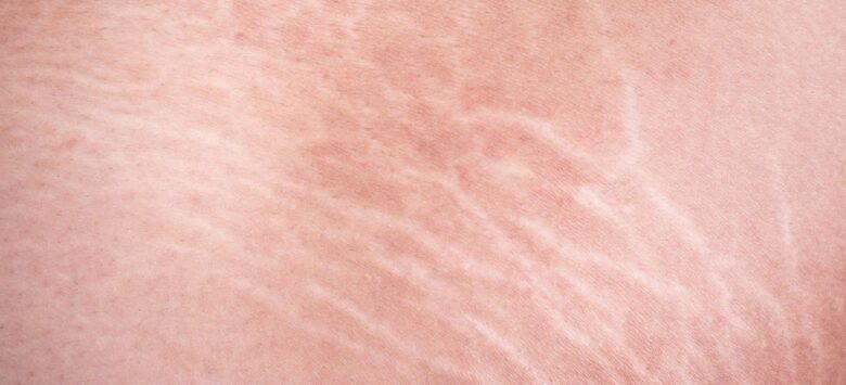 What Causes Stretch Marks and Who Is at Risk?