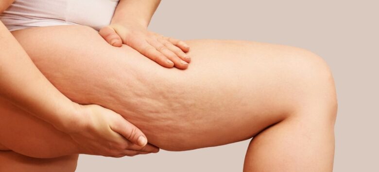 What Is Cellulite? Causes and Myths Debunked